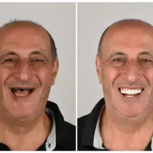 🦷 Denturelix™ Custom-Fit Functional Dentures 😁 Smile with Confidence