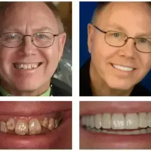 🦷 Denturelix™ Custom-Fit Functional Dentures 😁 Smile with Confidence