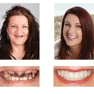 🦷 Denturelix™ Custom-Fit Functional Dentures 😁 Smile with Confidence