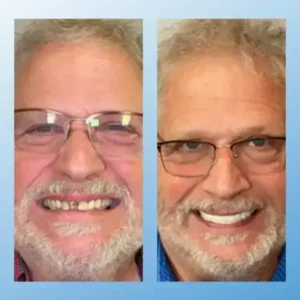 😁 “Snap In. Stay Put. Smile All Day — Or Your Money Back!” 𝗠𝗲𝗱𝗶𝗰𝗮𝗹-𝗚𝗿𝗮𝗱𝗲 𝗙𝘂𝗻𝗰𝘁𝗶𝗼𝗻𝗮𝗹 𝗧𝗵𝗶𝗰𝗸𝗲𝗻𝗲𝗱 𝗗𝗲𝗻𝘁𝘂𝗿𝗲𝘀