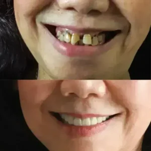 SmileFitPro BioFusion Dentures