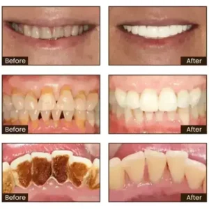 SmileFitPro™ Niacinamide Whitening Toothpaste